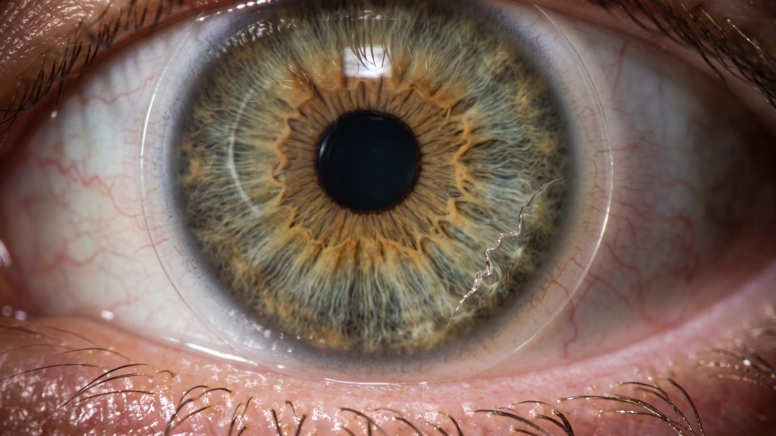 What to Do If a Contact Lens Tears or Breaks in Your Eye: Don't Panic, Do This - Daring Eyes